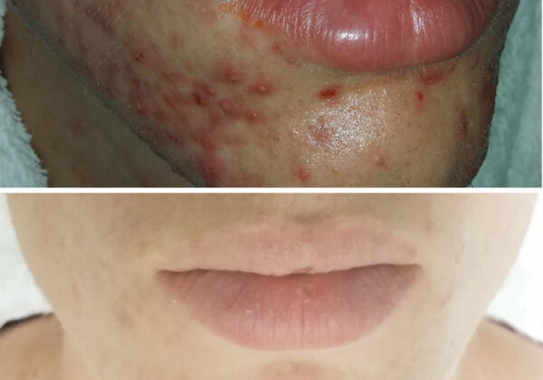 DMK Before And After Acne Toorak