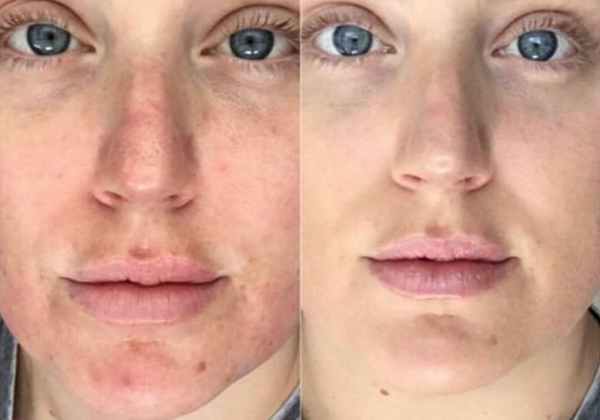 Acne Treatment before after Reverse Skin Clinic