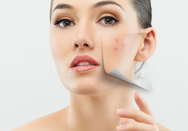 Acne treatment Reverse Skin Clinic Toorak, Melbourne