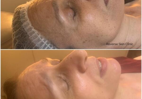 Pigmentation Before After Reverse Skin Clinic