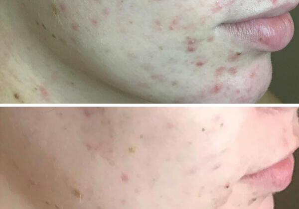 DMK Before And After Acne Toorak