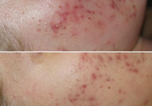 Reverse Skin Clinic Acne Before After