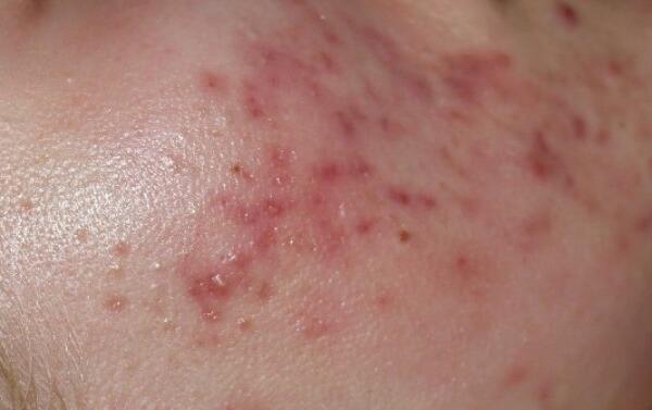 Reverse Skin Clinic Acne