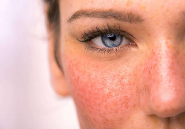 Rosacea Treatment Prahran