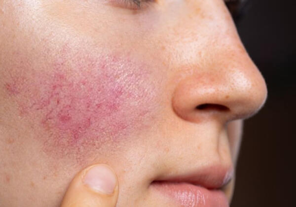 Rosacea Treatment South Yarra