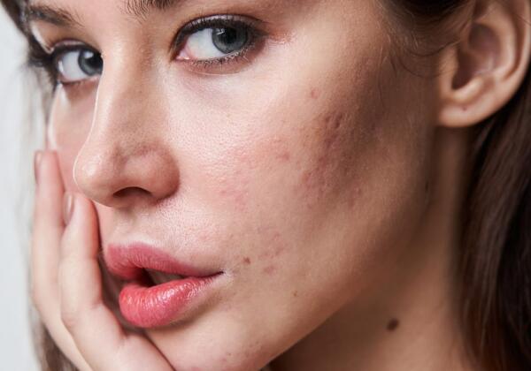 Acne Scarr Treatment Prahran