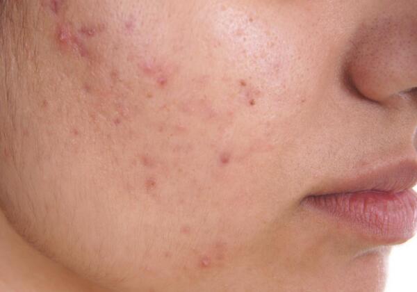 Acne Treatment South Yarra