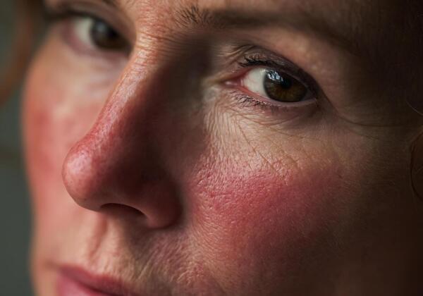 Rosacea Treatment Armadale